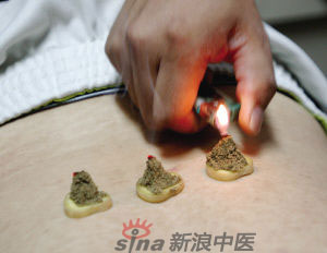 灸法的種類  你知道多少？