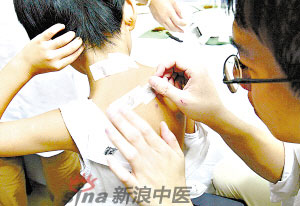 灸法的種類  你知道多少？